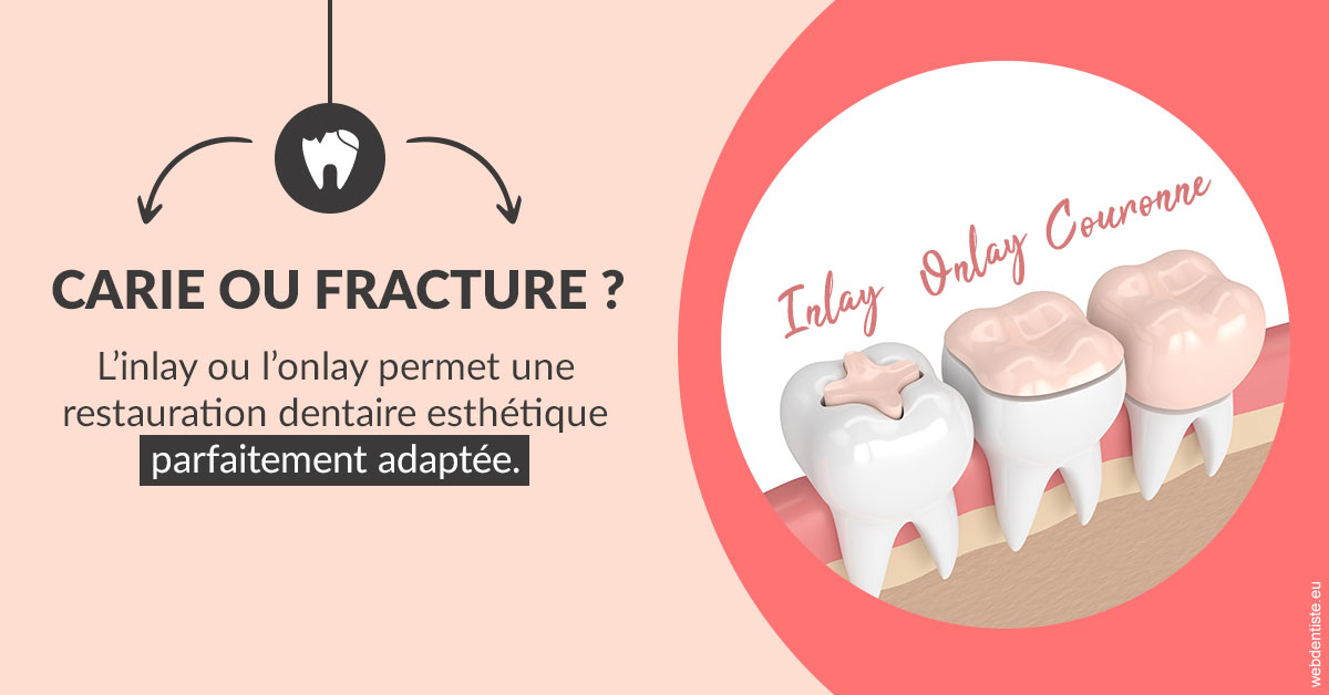 https://scp-chirurg-dentiste-drs-levy-nataf.chirurgiens-dentistes.fr/T2 2023 - Carie ou fracture 2