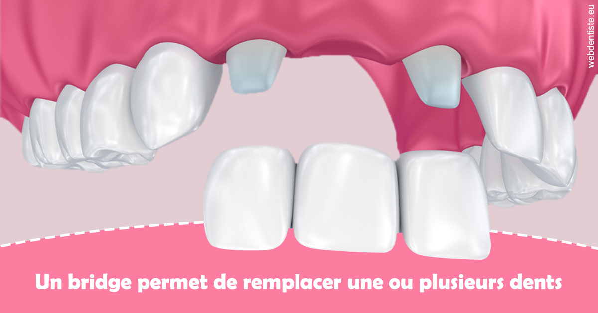 https://scp-chirurg-dentiste-drs-levy-nataf.chirurgiens-dentistes.fr/Bridge remplacer dents 2
