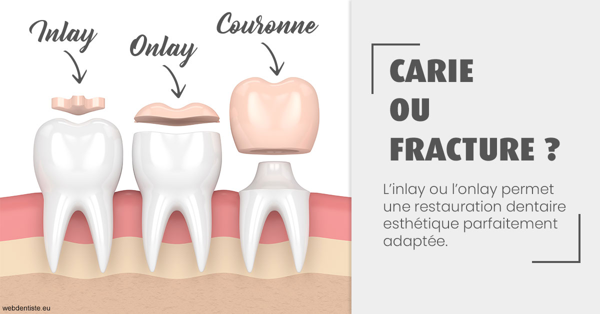 https://scp-chirurg-dentiste-drs-levy-nataf.chirurgiens-dentistes.fr/T2 2023 - Carie ou fracture 1
