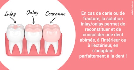 https://scp-chirurg-dentiste-drs-levy-nataf.chirurgiens-dentistes.fr/L'INLAY ou l'ONLAY 2