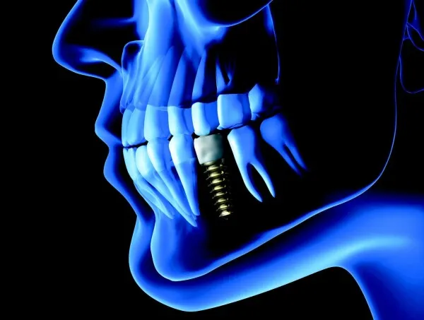 Qu’est-ce qu’un implant ? Indications et contre-indications